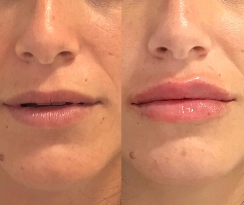 Tratamientos para labios