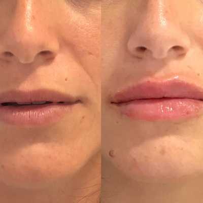 Tratamientos para labios