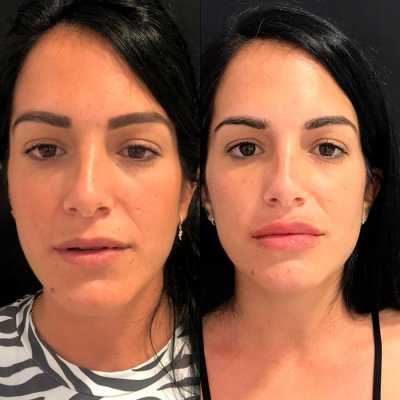 Tratamientos para labios