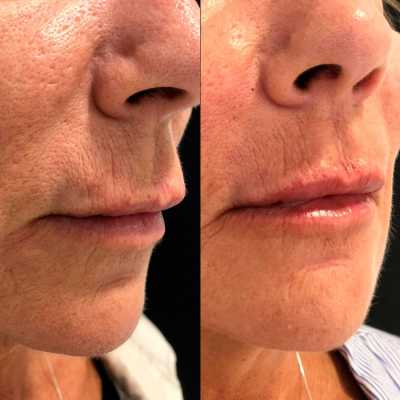 Tratamientos para labios